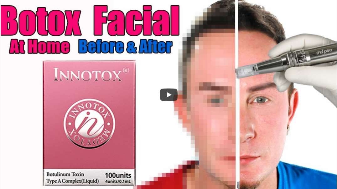 Botox Facial Microinfusion Before &amp;amp; After   How to Shrink Pores Fast
