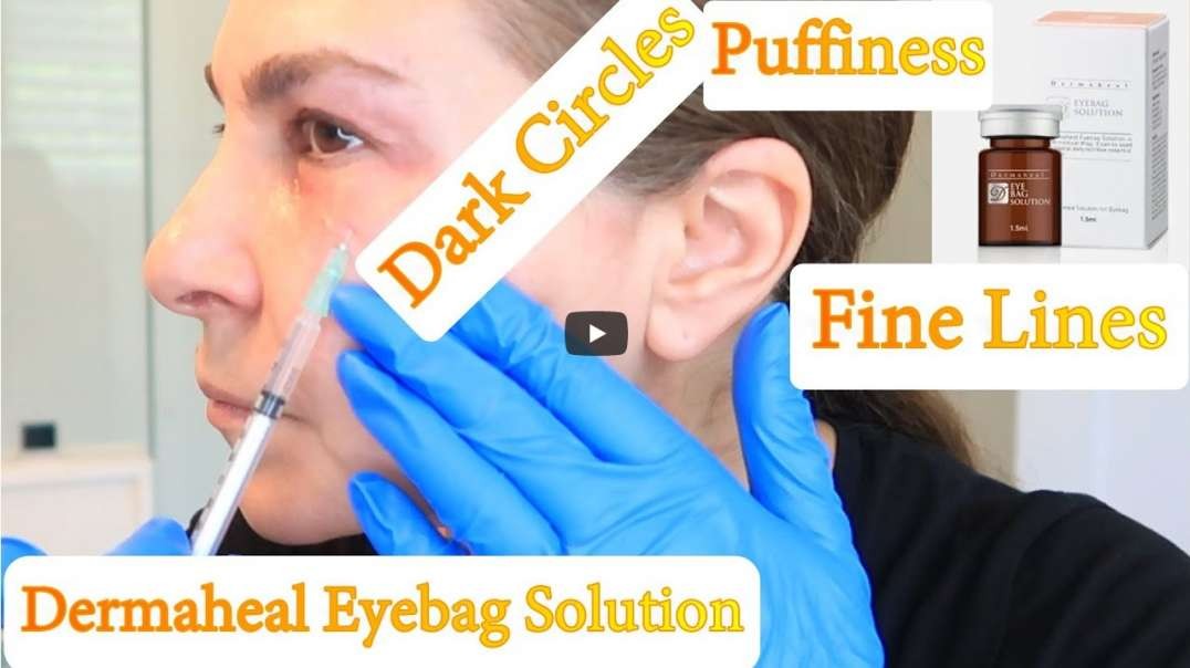 Dearmaheal Eyebag Solution Mesotherapy for Dark Circles, Puffiness, Wrinkles    PDO_Threads_DIY