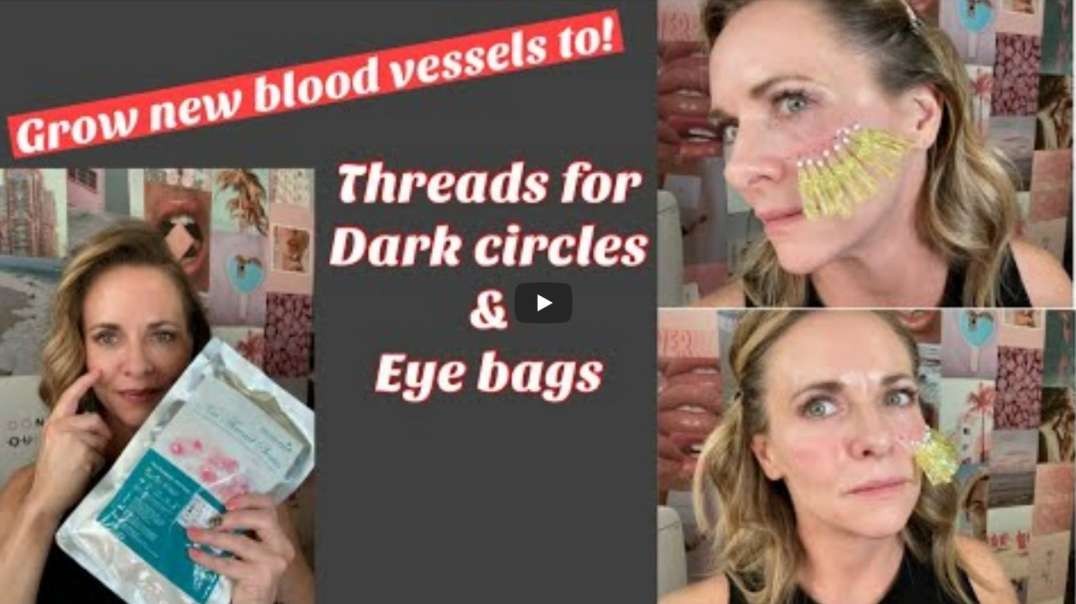 Under Eyes   Dark Circles   Eye Bags Treatment   Glamderma Threads