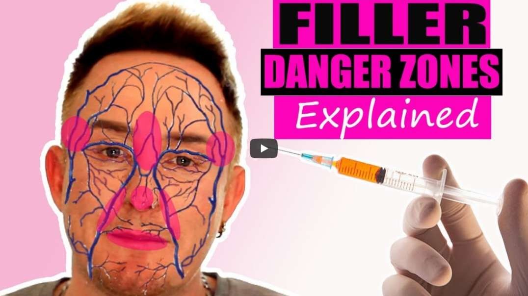 Facial Filler Danger Zones Visualisation   Avoid Filler Gone Wrong 2021